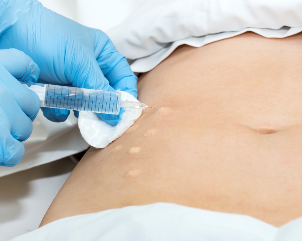 Gewichtsverlust mit Mesotherapie Gewichtsverlust mit Mesotherapie